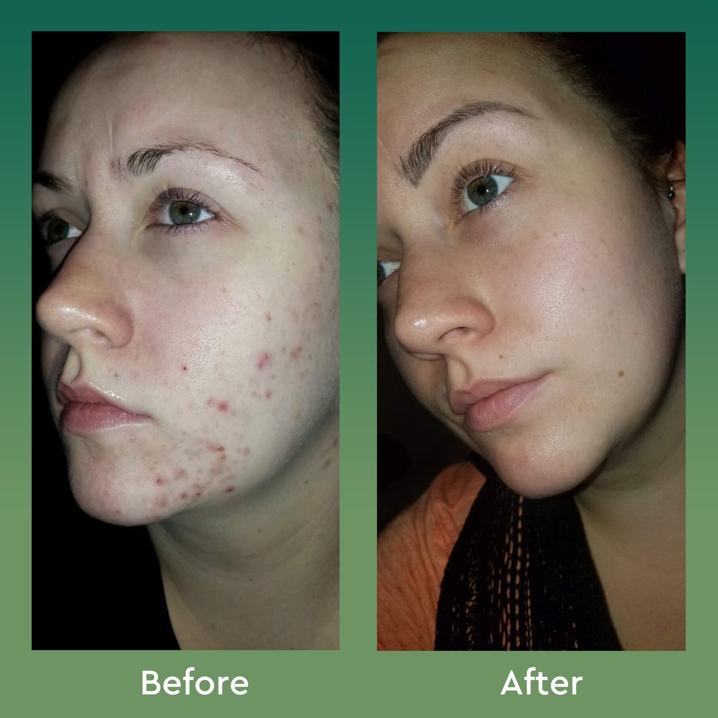 Clear Skin Acne Routine