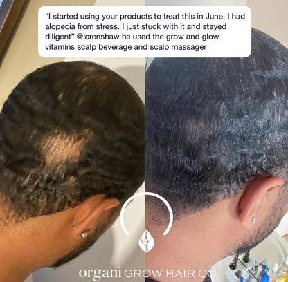Male Balding Pack