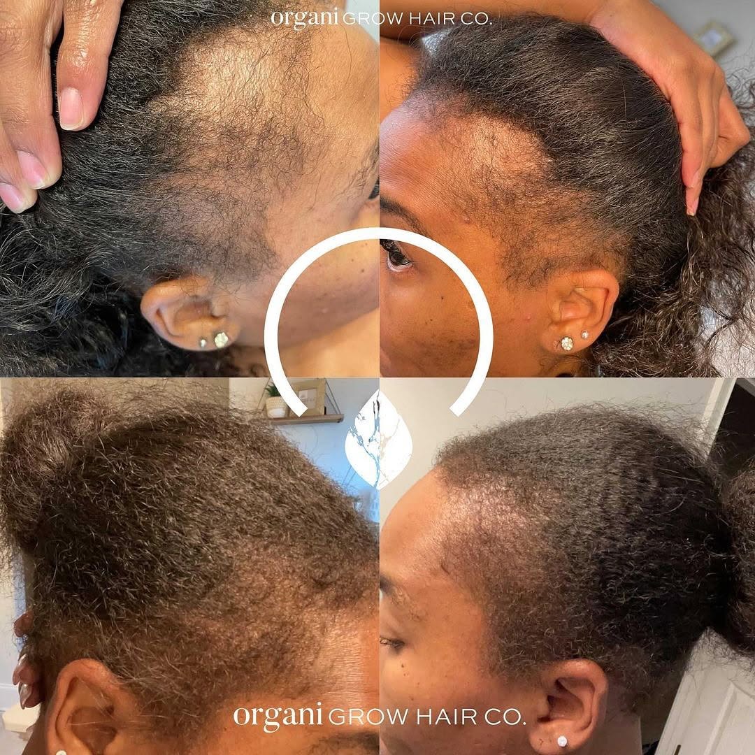 Stimulating Scalp Beverage - Medium Porosity with Black Seed Oil - Hair Growth Oil